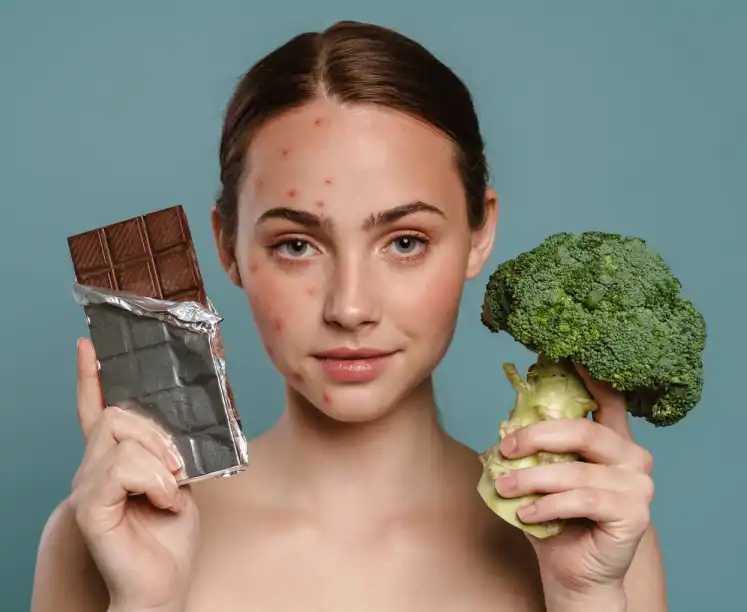 Sivilce Tedavisinde Göz Ardı Edilen Gerçek: Beslenme